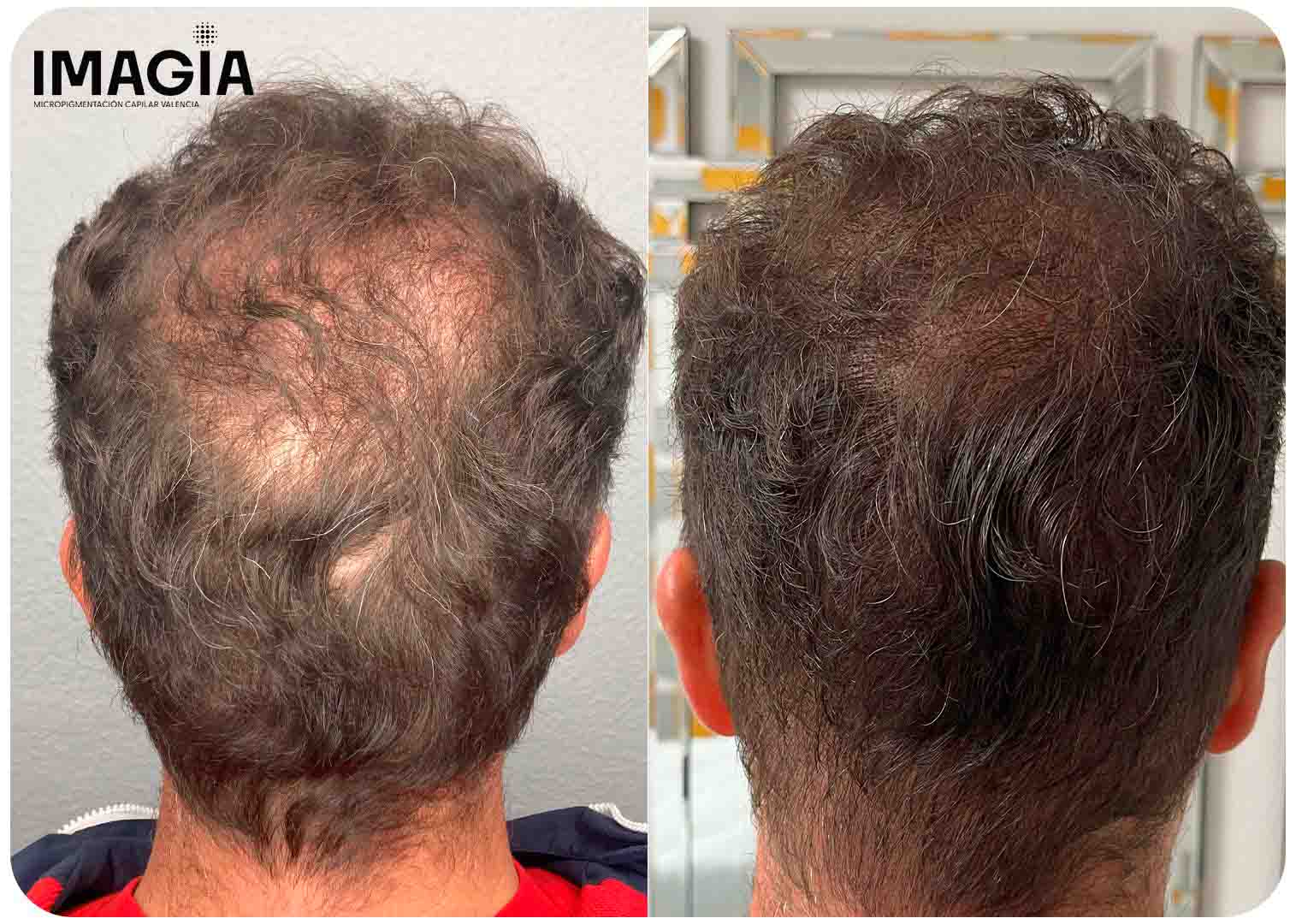 Resultado micropigmentación mujer - Mayor densidad visual