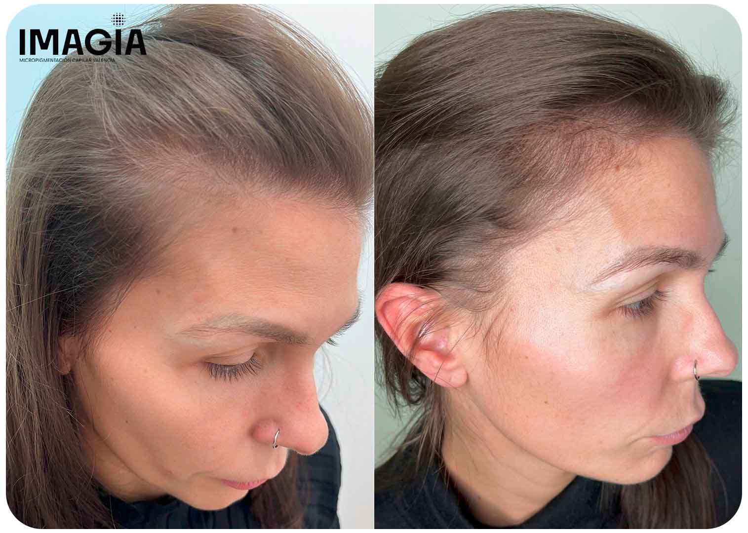 micropigmentacion capilar Valencia densidad femenina