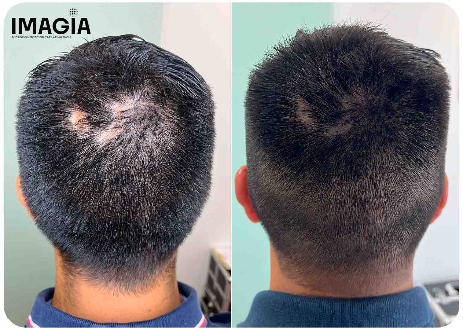 Cicatrices FUE - Antes micropigmentación capilar