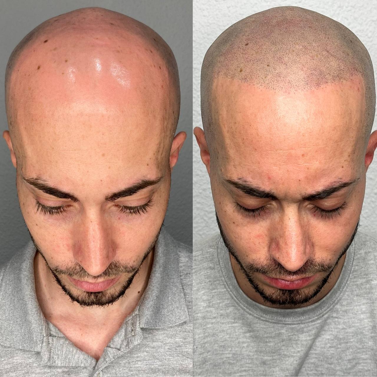 Madrid alopecia androgénica avanzada