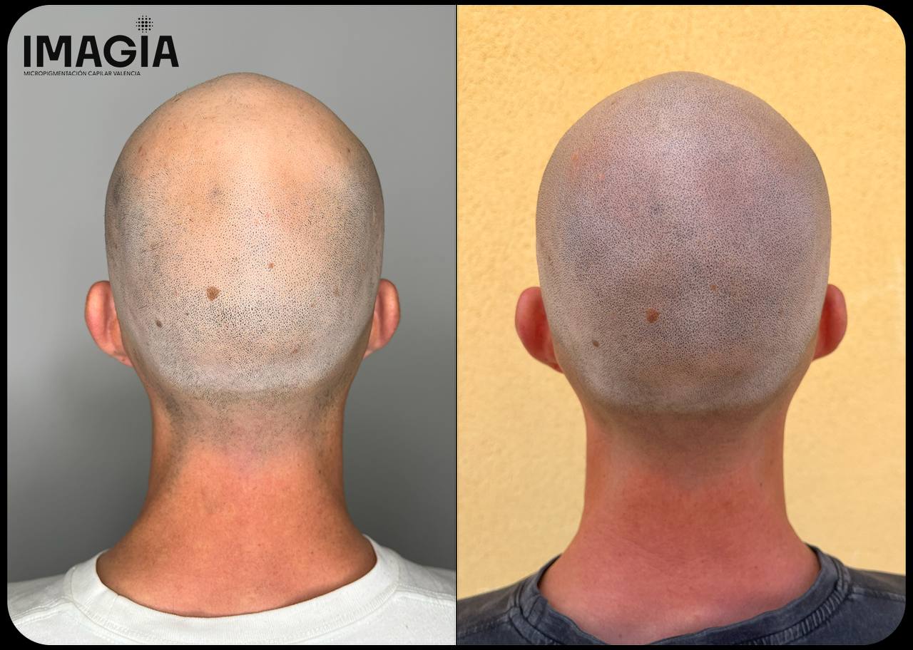 Camuflaje de cicatriz capilar con micropigmentación - ejemplo real