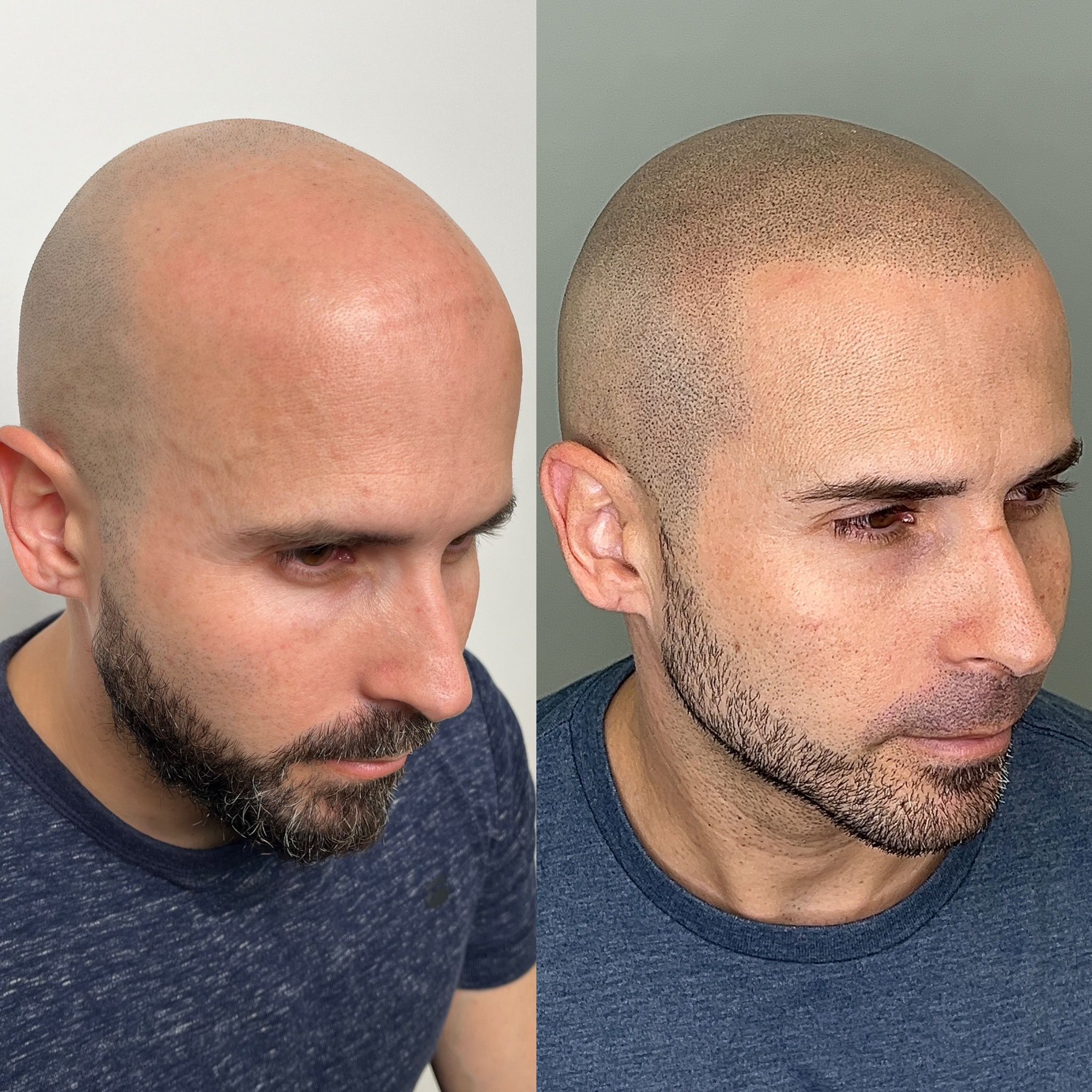 Alopecia Androgénica Avanzada - Caso real micropigmentación capilar España