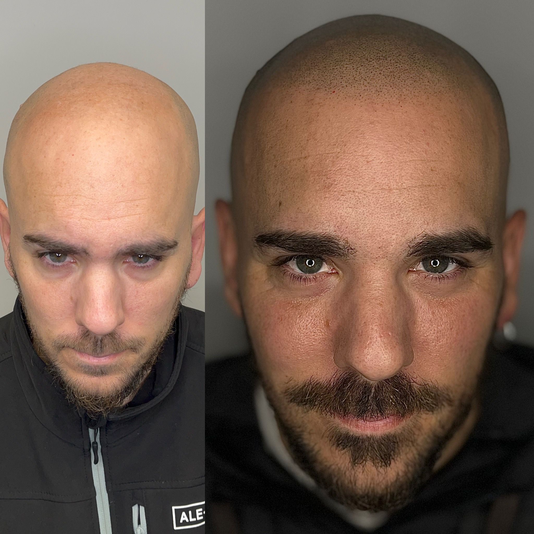 Resultado micropigmentación capilar - Efecto rapado natural España