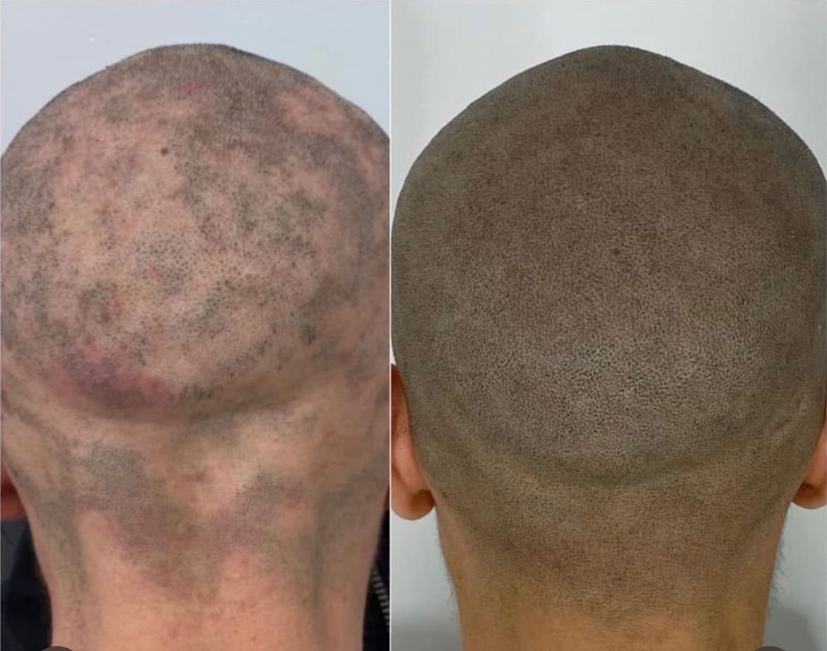 Alopecia Areata - Micropigmentación Capilar España