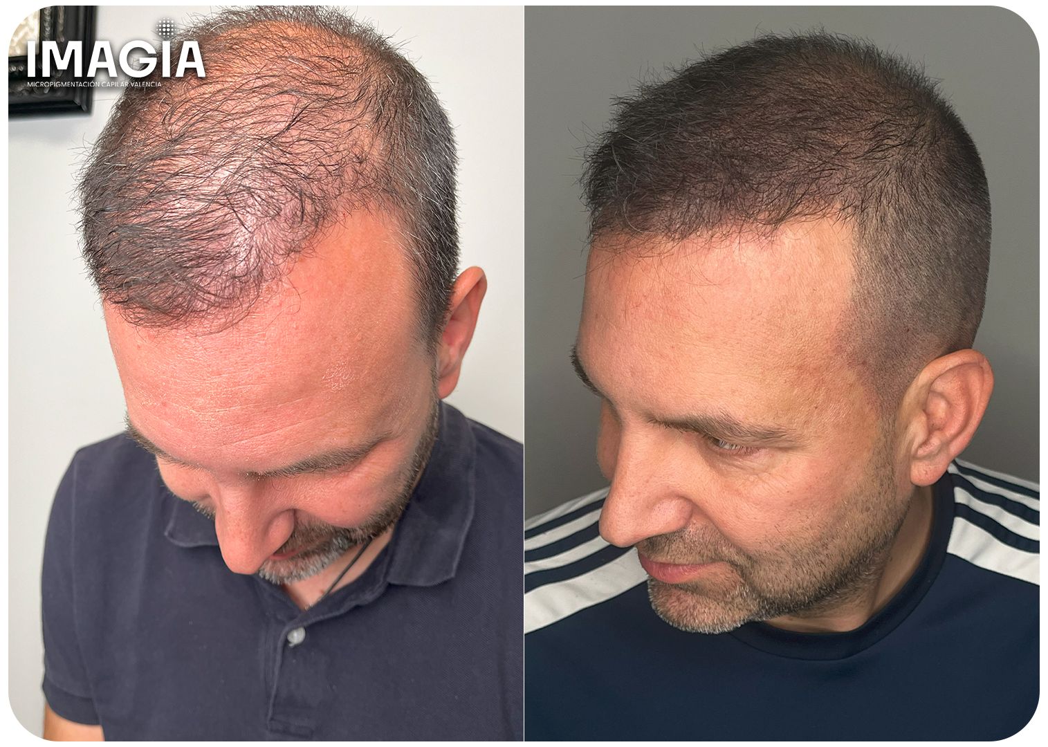 Densidad masculina - Micropigmentación España