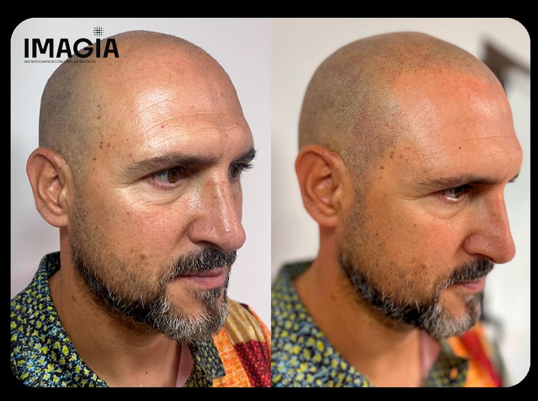 micropigmentacion capilar Gandia efecto rapado hombres